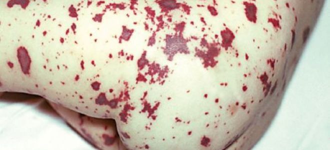 Признаки менингита у детей, сыпь при менингите (фото), как распознать менингит – симптомы у детей