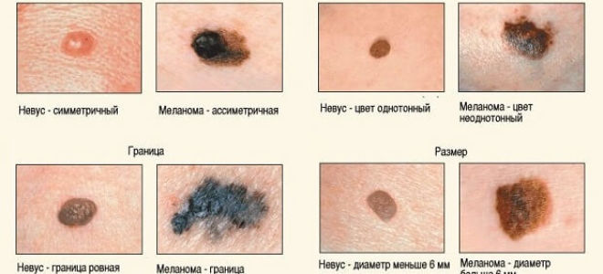 Коричневые пятна на ногтях рук и ног: провоцирующие факторы и причины пигментации, методы диагностики и лечения, длительность терапии, прогноз и меры профилактики