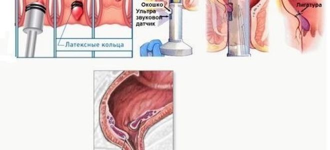 Не проходит геморрой: что делать, если долго не заживает геморройная шишка