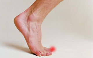 Мази от грибка на ногах – 10 лучших средств для лечения