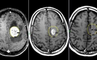 Метастазы в головном мозге: продолжительность жизни, симптомы, лучевая терапия при метастазах мозга
