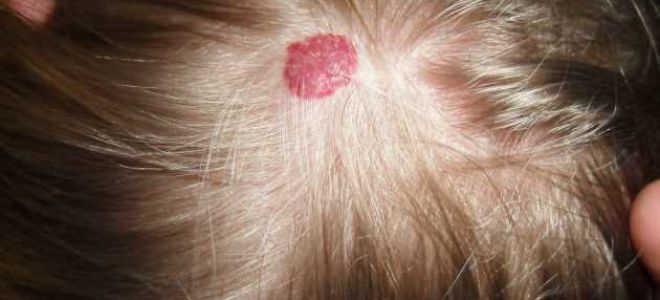 Образовался шарик или шишка на голове под кожей (у ребенка или взрослого): частые причины и лечение, виды уплотнений, к какому врачу следует обратиться