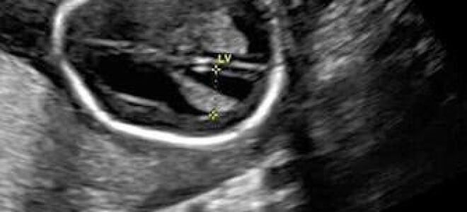 Вентрикуломегалия у грудничка: что это и насколько опасно?