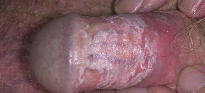 Грибок на члене: симптомы и признаки