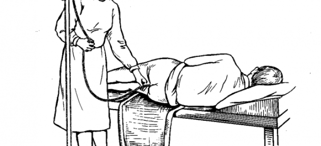 Каловые камни в кишечнике: причины, симптомы и лечение копролитов