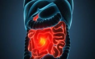 Дивертикулез кишечника: симптомы и лечение народными средствами у взрослых, какое питание и диета при заболевании или его диагностика