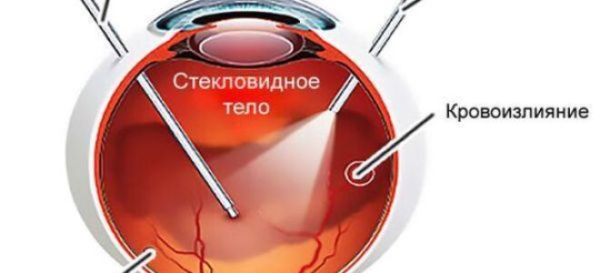 Мушки перед глазами (черные, прозрачные, бесцветные), причины пелены, лечение