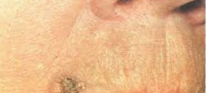 Предраковые заболевания пищеварительной системы