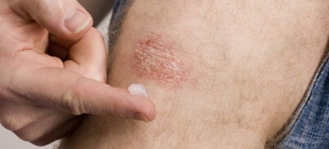 Маленькие красные шелушащиеся сухие пятна на теле: причины появления