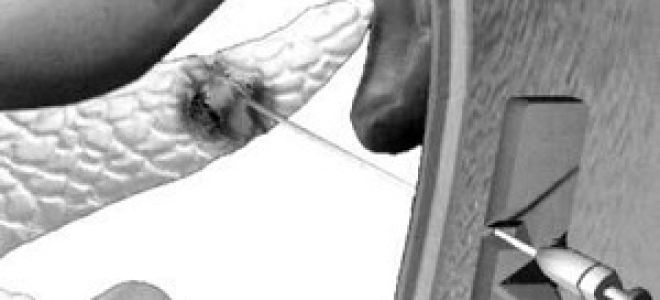 Нормы узи поджелудочной железы: расшифровка результатов у взрослых и детей. поджелудочная железа на узи белого цвета