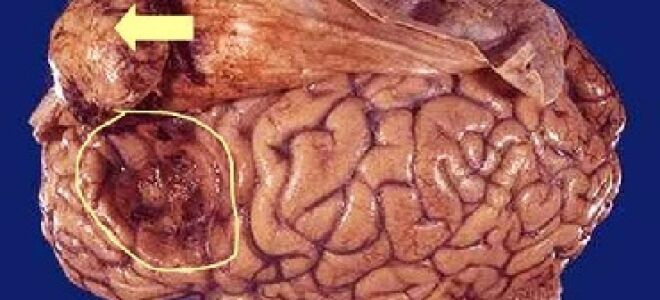 Менингиома головного мозга: прогноз жизни и лечение