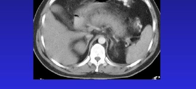 Симптомы панкреатита у женщин