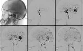 Кавернозная ангиома головного мозга: лечение, прогноз