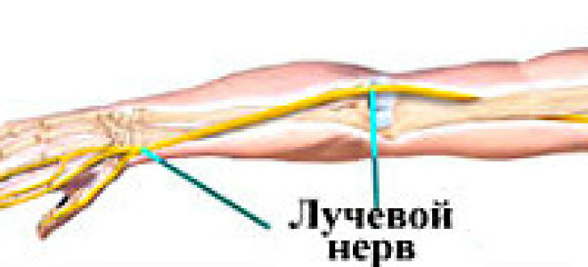 Невропатия лучевого нерва руки: симптомы и лечение