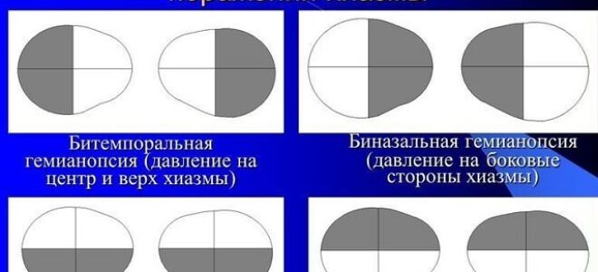 Гемианопсия (гомонимная, битемпоральная, биназальная, контралатеральная) при инсульте