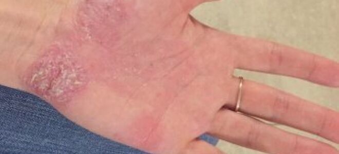 Псориаз — симптомы, причины появления, лечение, фото