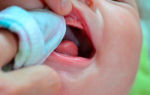 Молочница во рту у ребенка — чем лечить?