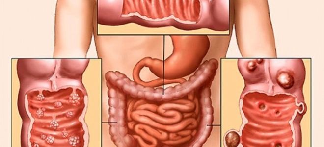 Лейкопения: лейкоциты при онкологии — сколько должно быть, уровень лейкоцитов при раке, показатели