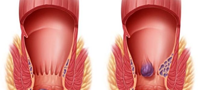 Как рассосать геморроидальный узел