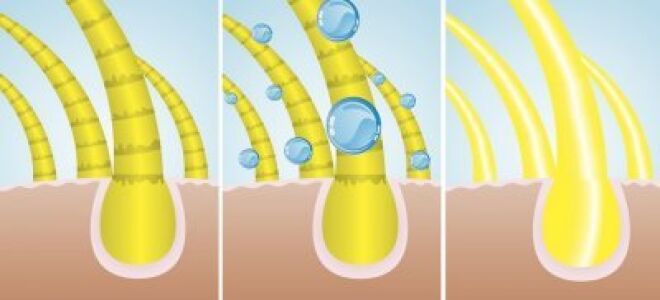 Самые эффективные способы лечения жирной себореи кожи головы