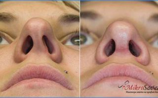Септопластика носовой перегородки: отзывы, цена, фото до и после, лазерная, эндоскопическая и другие виды коррекции носа, последствия, возможные осложнения и реабилитация после операции