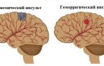 Нарушение кровообращения головного мозга: симптомы, лечение, препараты