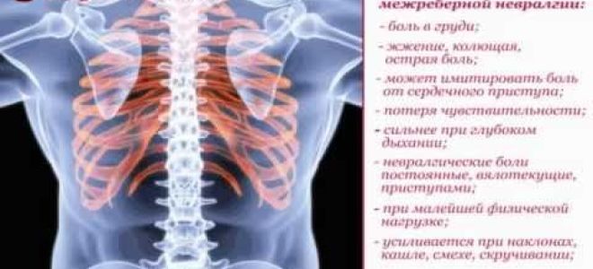 Межреберная невралгия — что это такое, симптомы и лечение в домашних условиях