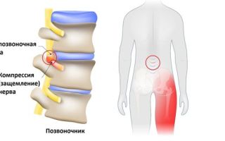 Воспаление седалищного нерва — симптомы и лечение защемления седалищного нерва