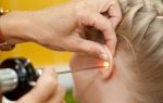 Отит среднего уха — симптомы и лечение у взрослых, как лечить воспаление уха при наружном, гнойном, остром и хроническом отите антибиотиками