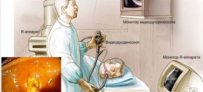 Симптомы и лечение панкреатита у мужчин