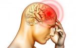 Почему рвота при мигрени — симптомы и лечение болезней