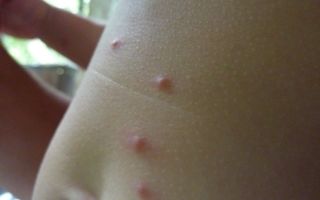 Аллергия на коже — красные пятна чешутся, лечение (фото)