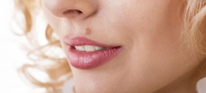 Виды невусов на голове (фото)