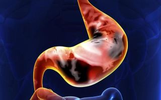 Перстневидноклеточный рак желудка: сколько живут?