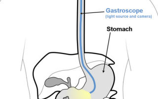 Гастроскопия желудка — как проводится, как подготовиться, правила питания