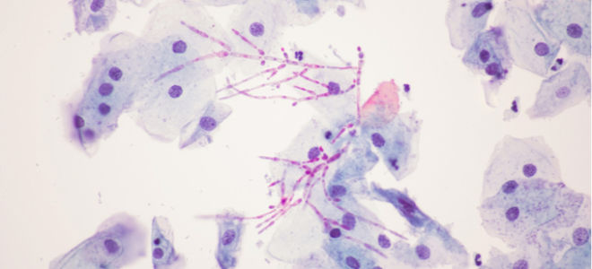 Candida albicans — что это такое: симптоматика и лечение