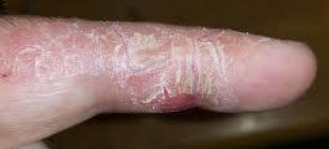 Трескается кожа на пальцах рук и шелушится