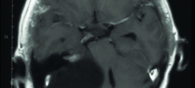 Невринома слухового нерва: симптомы, лечение и удаление