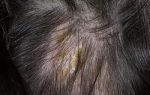 Себорейный дерматит волосистой части головы — лечение себорейного дерматита на голове у взрослых