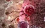 Что такое метастазы и на какой стадии рака появляются