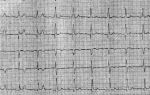 Нарушение внутрижелудочковой проводимости сердца: что это такое, лечение