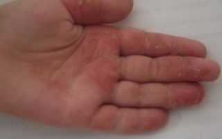 Дерматит у ребенка на руках: фото, причины, симптомы, лечение