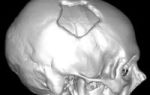 Лучевая диагностика перелома мыщелка затылочной кости