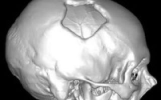 Лучевая диагностика перелома мыщелка затылочной кости