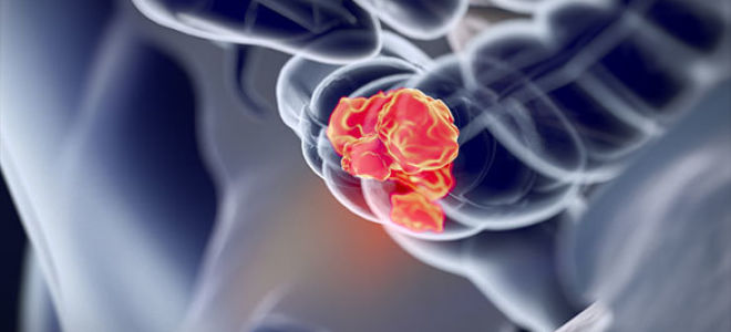 Рак прямой кишки: эффективное лечение современными методами