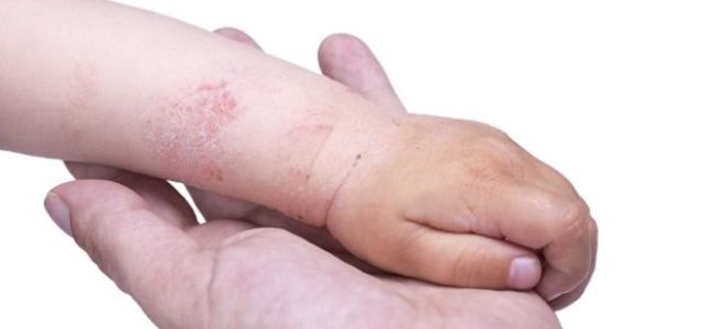 Нейрогенный дерматит (нервный): причины, симптомы, лечение