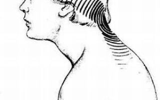 Боль в шее при повороте головы (резкая, острая): причины и лечение