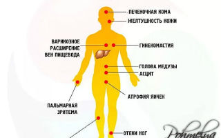 Симптомы цирроза печени у мужчин алкоголиков и лечение болезни