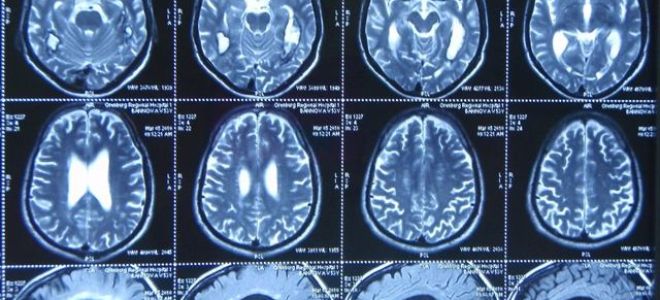 Ээг или мрт головного мозга: отличие, что лучше?