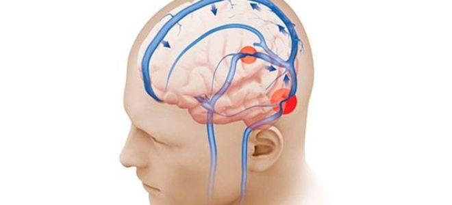 Венозная дисциркуляция: признаки и лечение дисфункции головного мозга